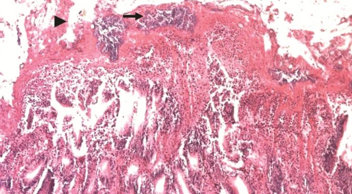 Gambaran Makroskopis dan Mikroskopis Necrotic Enteritis